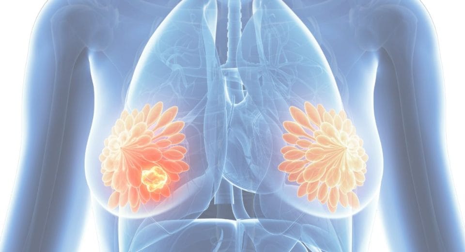 Breast Cancer - Featured Image